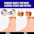 Warts Remover ointment
